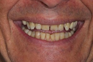 La sonrisa del paciente antes de las coronas y la unión.
