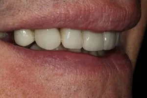 Patient's mouth after crowns and bonding