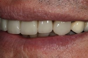 Patient's mouth after crowns and bonding