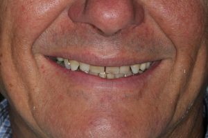 Patient's smile before crowns and bonding