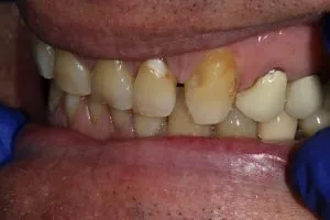 Patient's mouth before crowns and bonding