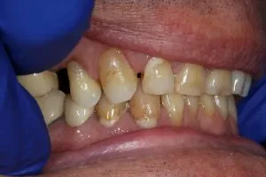 Patient's mouth before crowns and bonding