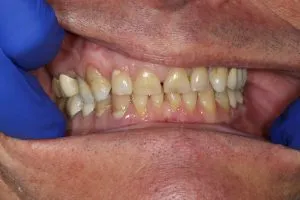 Patient's mouth before crowns and bonding