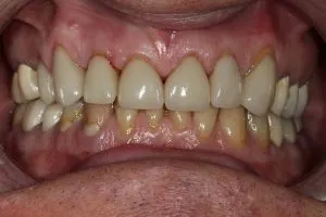 Patient's mouth after crowns and bonding