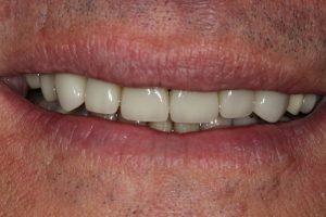 Patient's smile after crowns and bonding