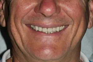 Patient's smile after crowns and bonding