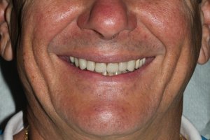 La sonrisa del paciente después de las coronas y la unión.