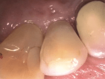 Dientes del paciente después del relleno con composite