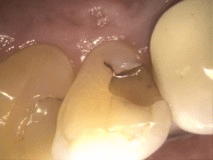 Dientes del paciente antes del relleno con composite