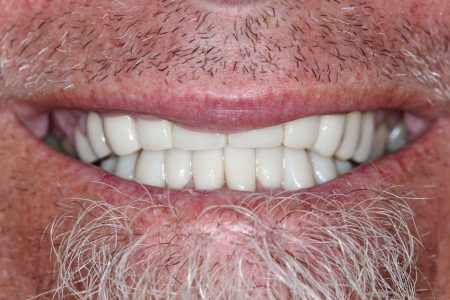 Dental Crown and Dental Bridge After