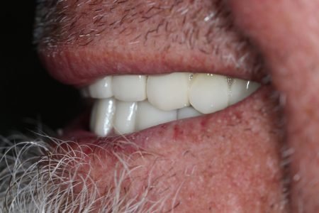 Dental Bridge and Dental Crown After