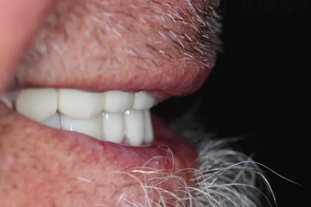 After Dental Crown and Dental Bridge