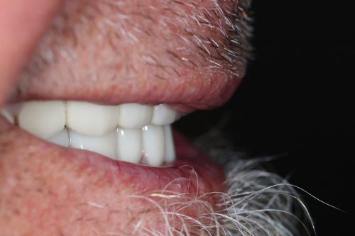 After Dental Crown and Dental Bridge