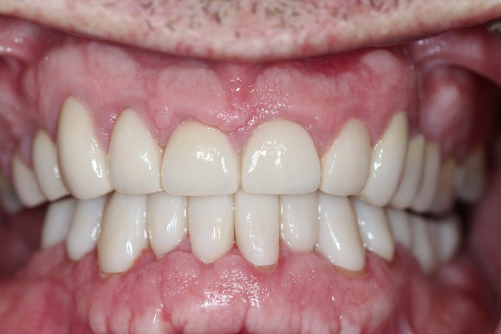After Dental Bridge and Dental Crown