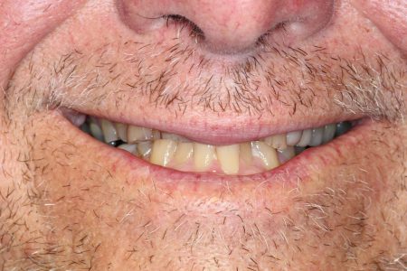 Dental Crown and Dental Bridge Before