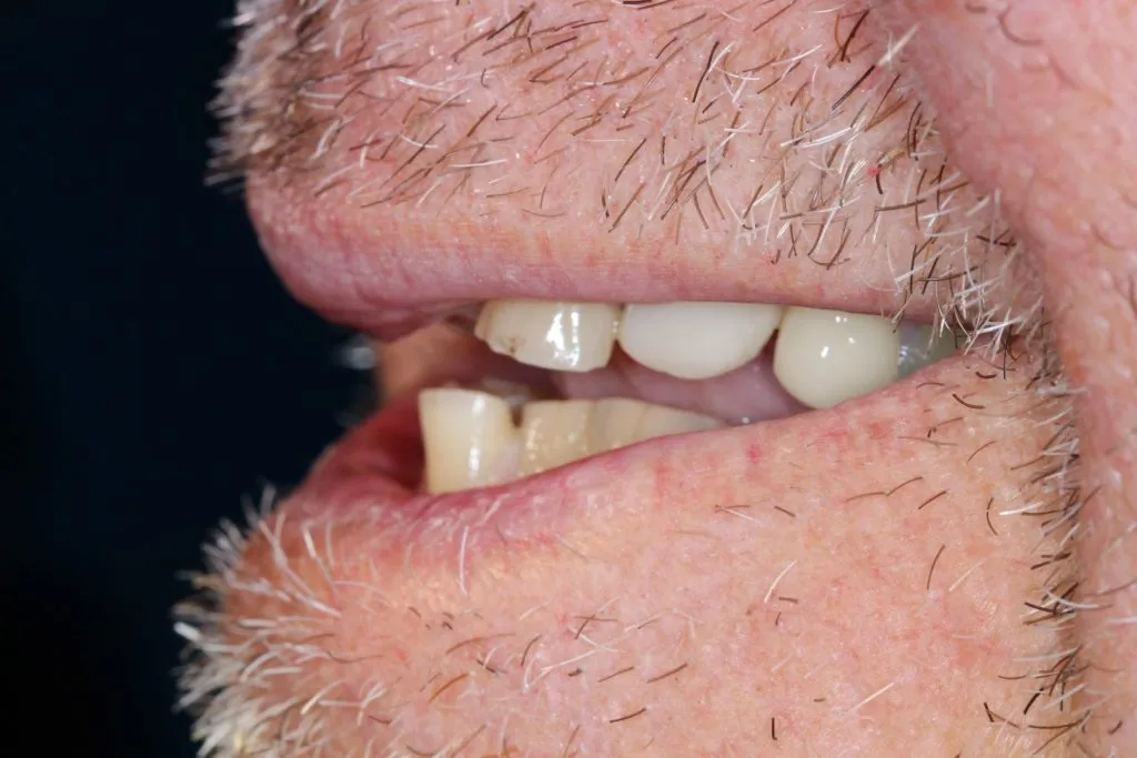 Dental Bridge and Dental Crown Before