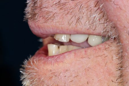 Dental Bridge and Dental Crown Before
