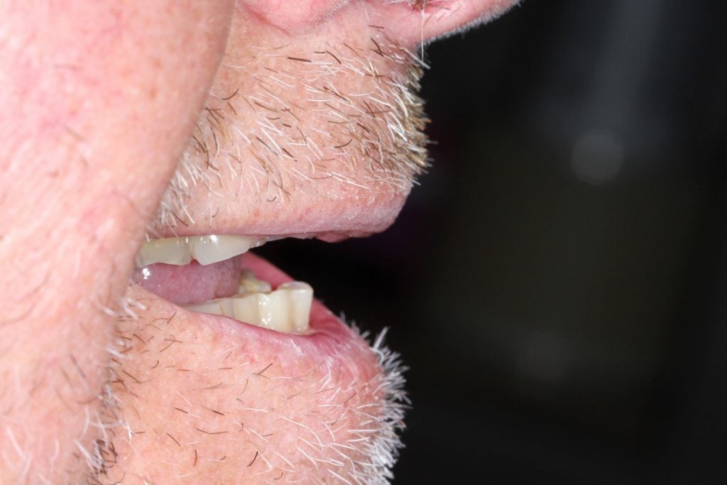Before Dental Crown and Dental Bridge