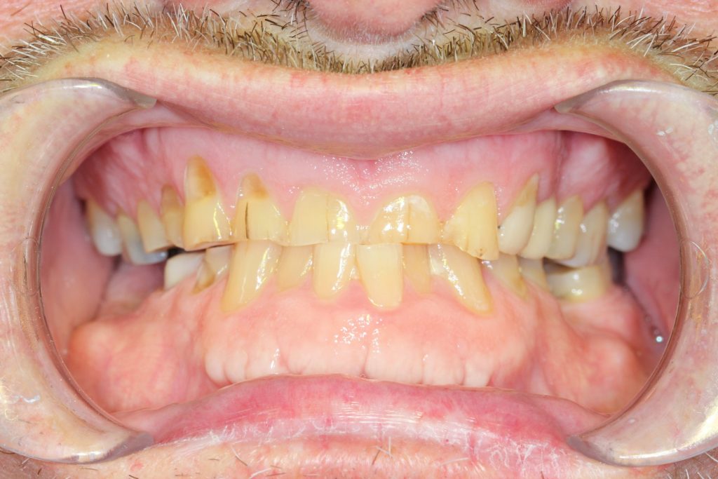 Before Dental Bridge and Dental Crown