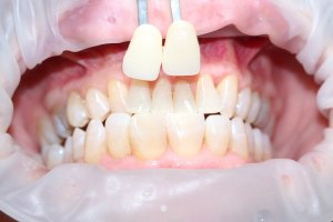 In-office whitening case