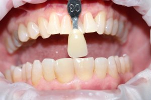 In-office whitening case
