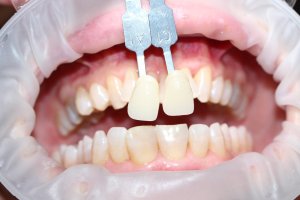 In-office whitening case